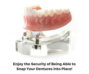 Enjoy the Security of Being Able to Snap Your Dentures into Place 300x251 1