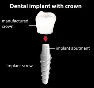 Root Form Dental Implant 300x282 1