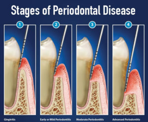 stages of periodontal disease crop