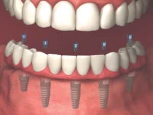 all on implant screw retained