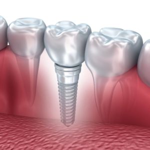 Implant and crown