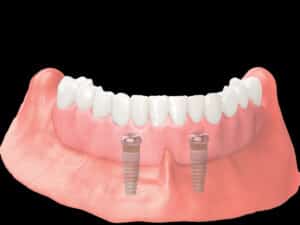 locator denture on black