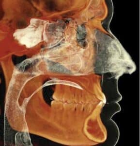 OSA cbct