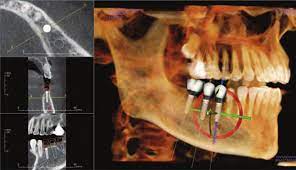 anatomage implant