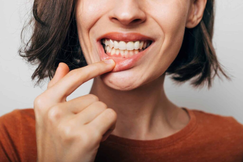 Close,Up,Shot,Of,Gum,Inflammation.,Cropped,Shot,Of,A