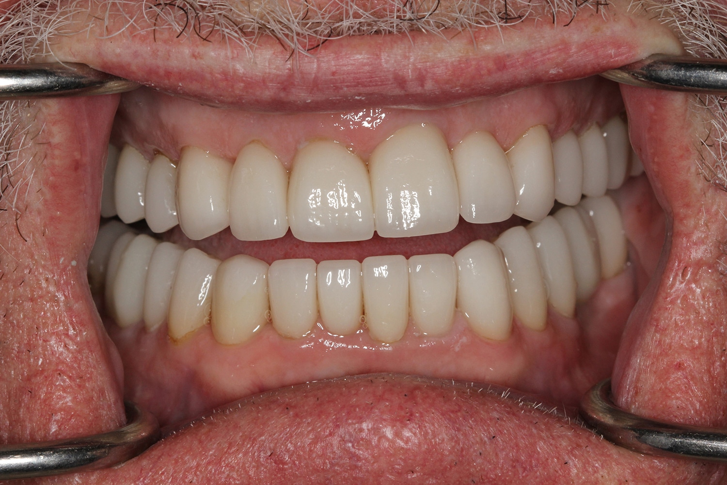After Image: Full Mouth Rehab - front
