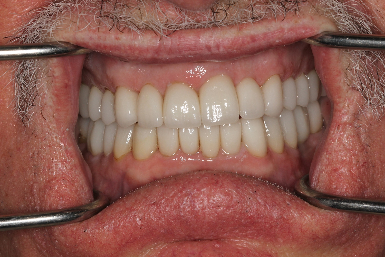 After Image: Full Mouth Rehab - front