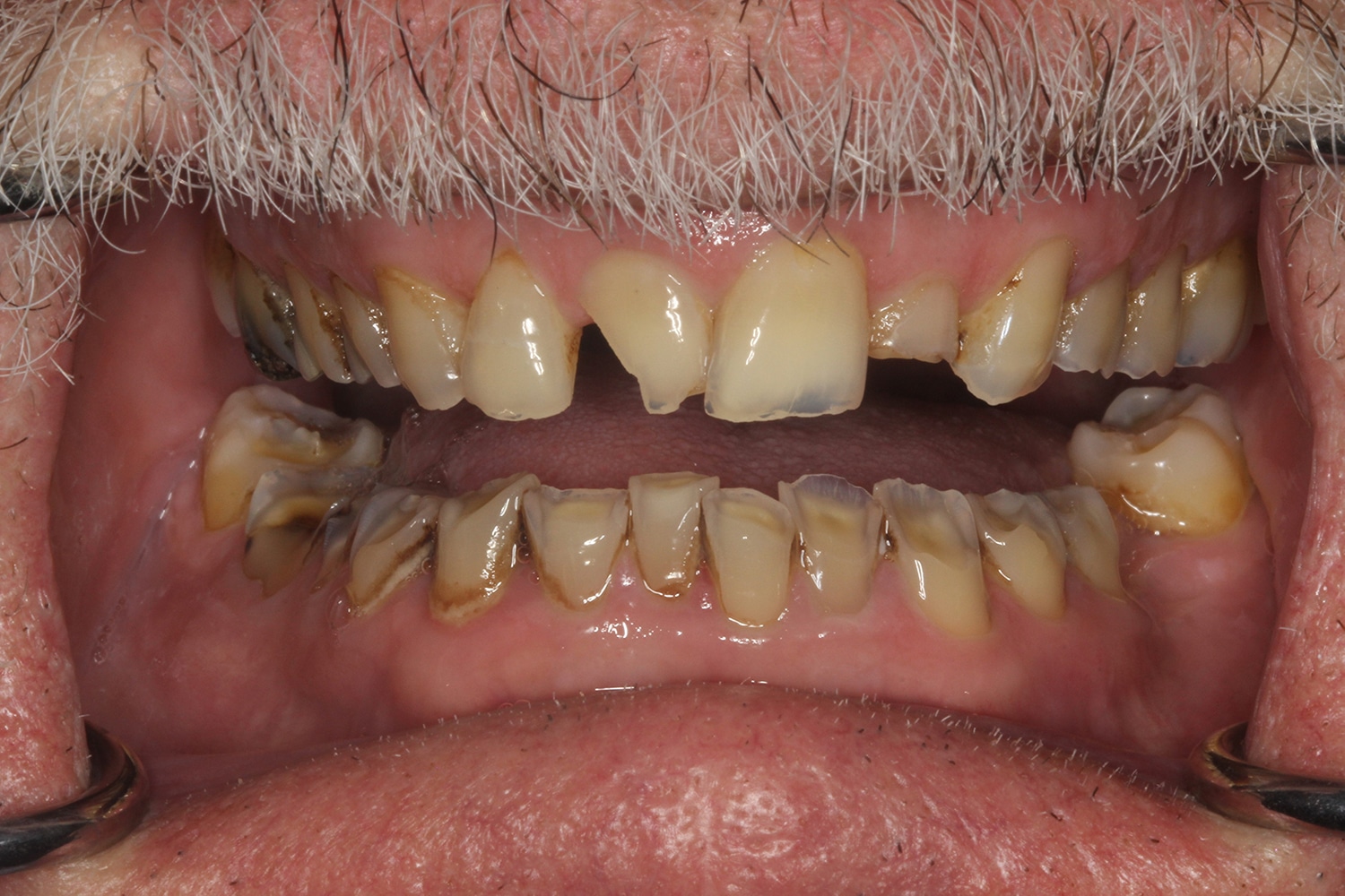 Before Image: Full Mouth Rehab - front
