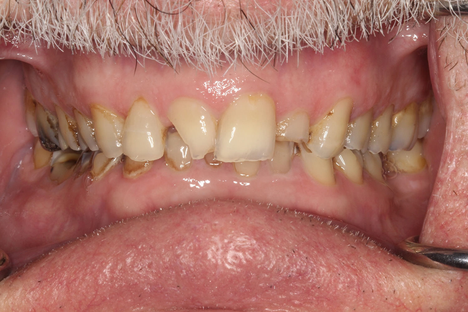 Before Image: Full Mouth Rehab - front