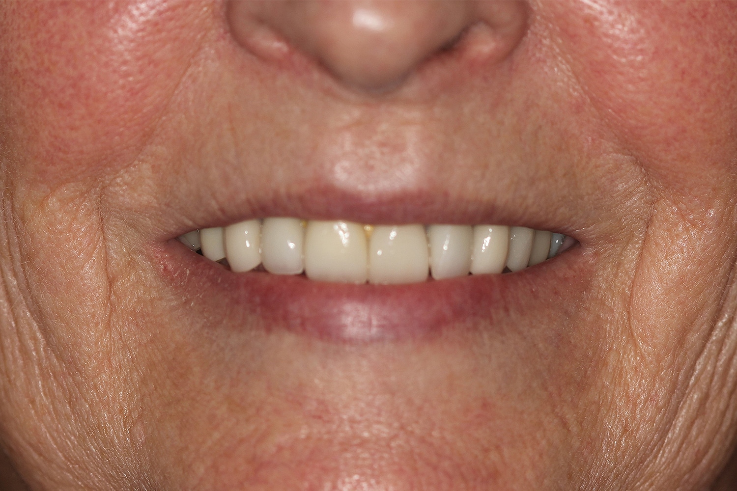 After Image: Cosmetic Veneers - front