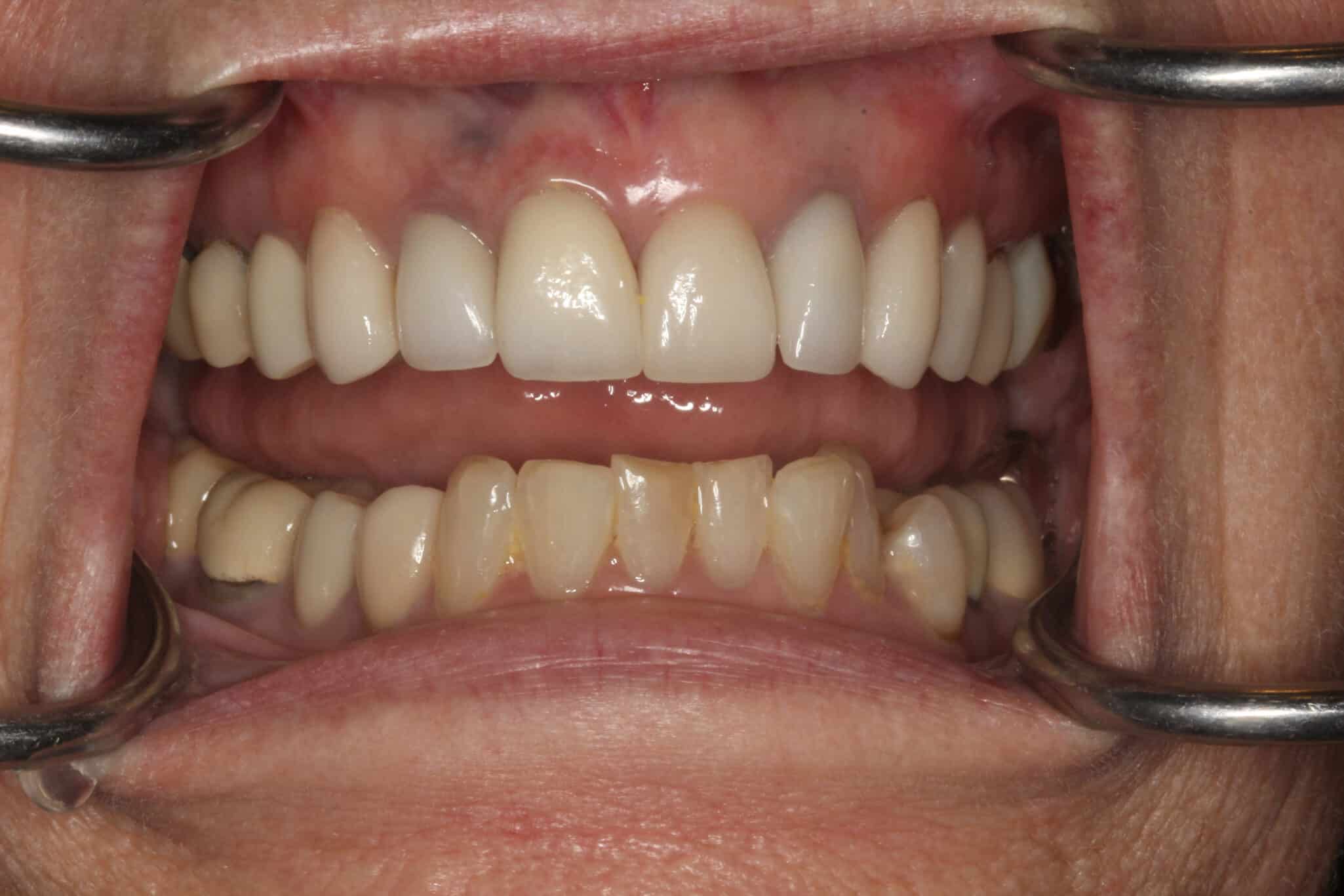 After Image: Cosmetic Veneers - front
