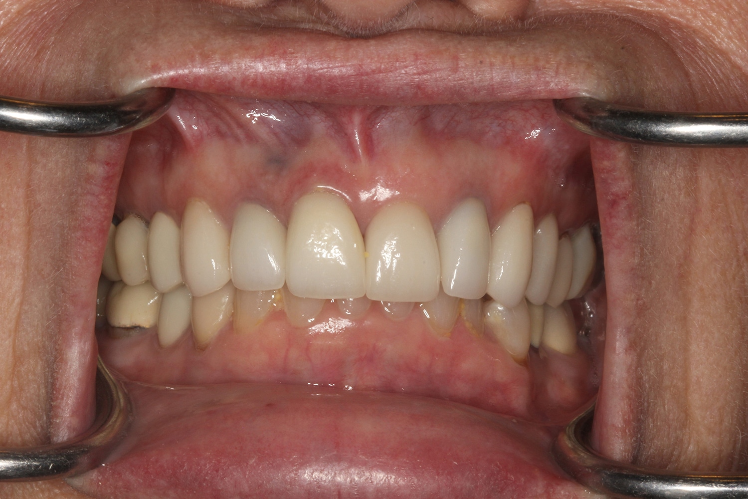 After Image: Cosmetic Veneers - front