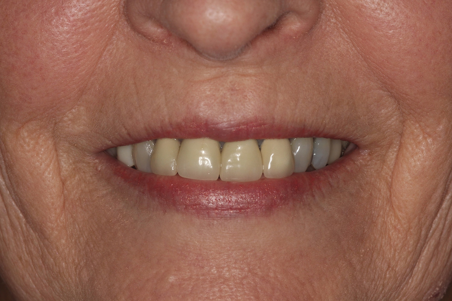 Before Image: Cosmetic Veneers - front