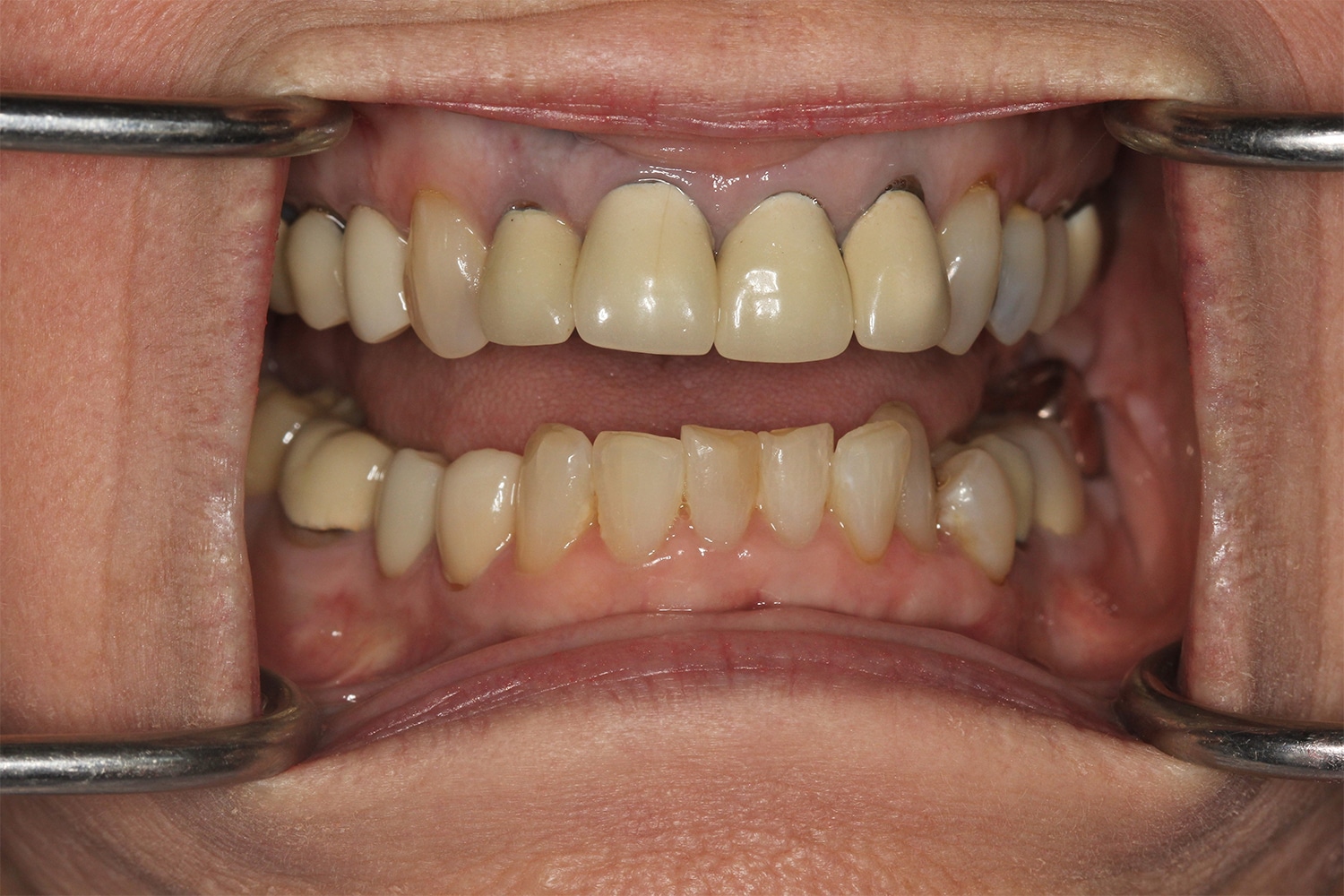 Before Image: Cosmetic Veneers - front