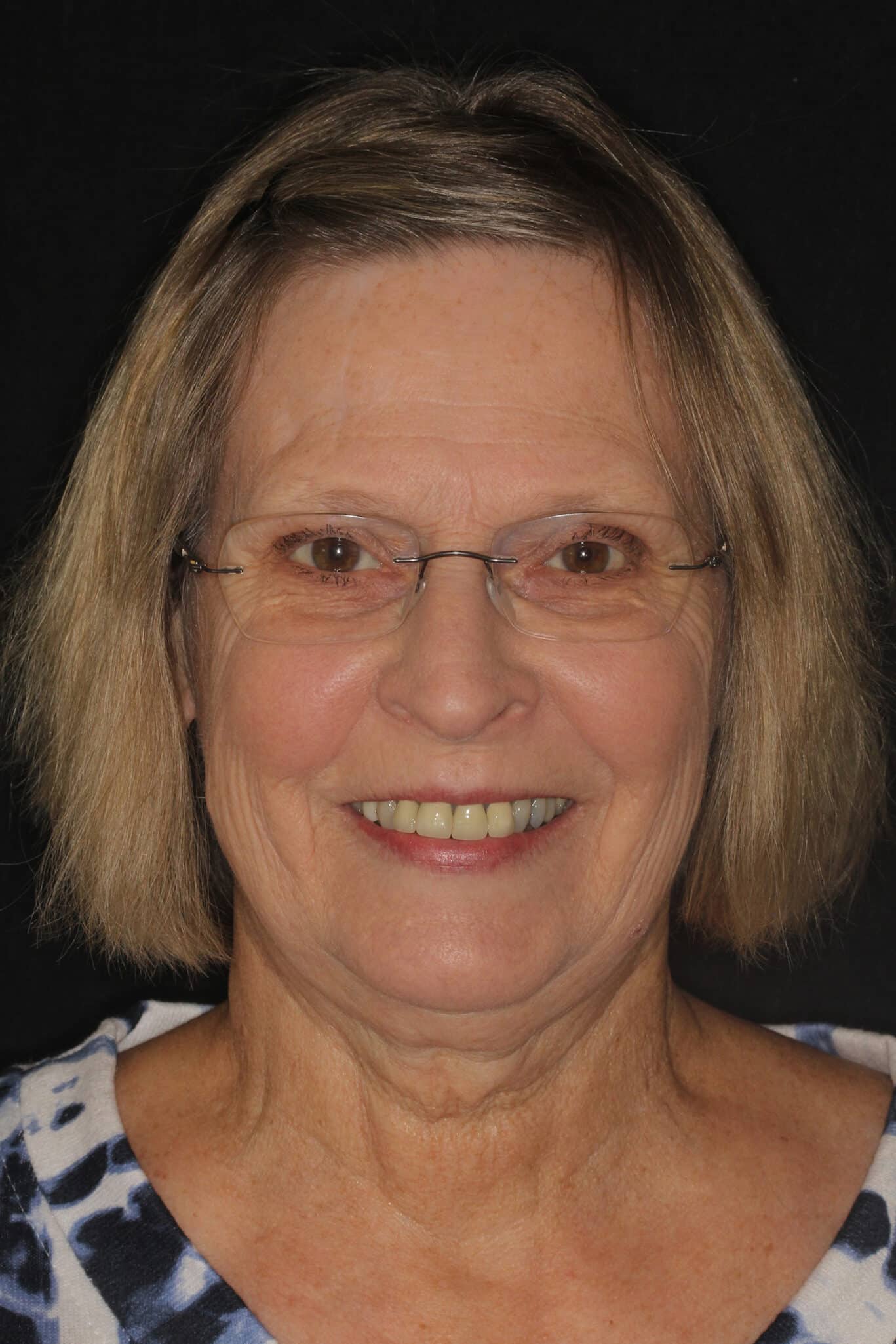 Before Image: Cosmetic Veneers - front