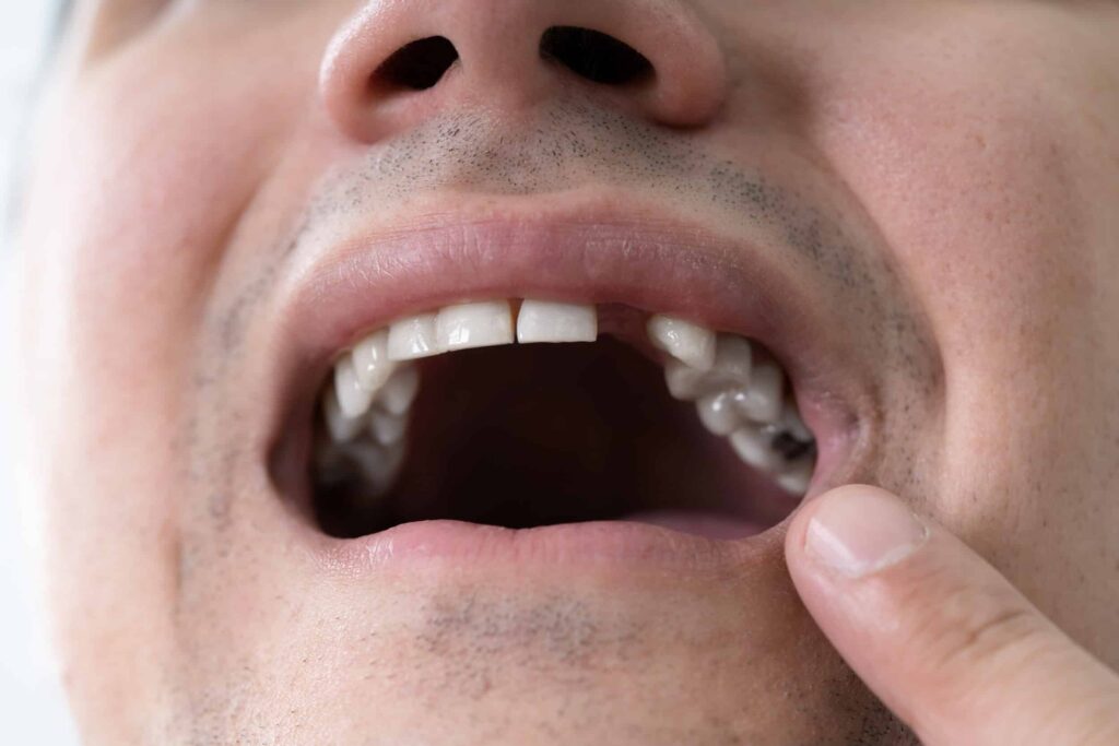 Close-up photo of a man's mouth with a missing tooth. Prompt replacement can restore functionality and the appearance of his smile