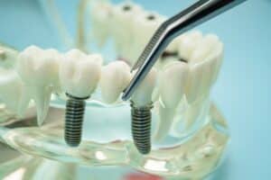 Dental model with implant and dentist tools, representing tooth restoration and implant dentistry procedures