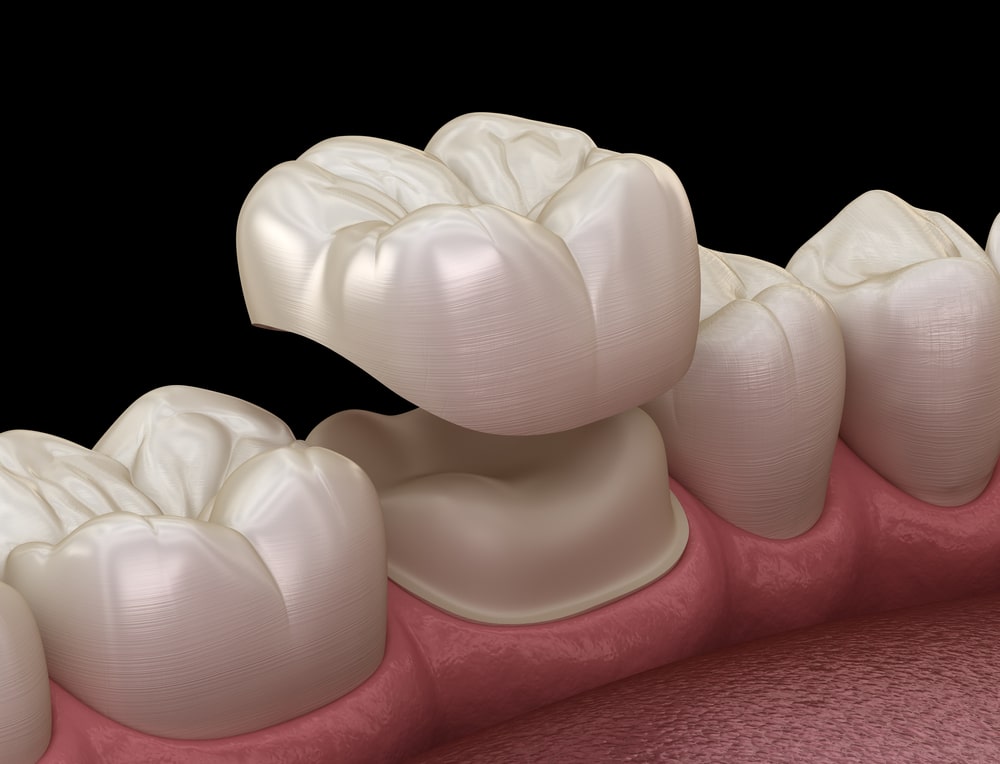 3D-rendering of a porcelain crown placed on the top of a tooth.